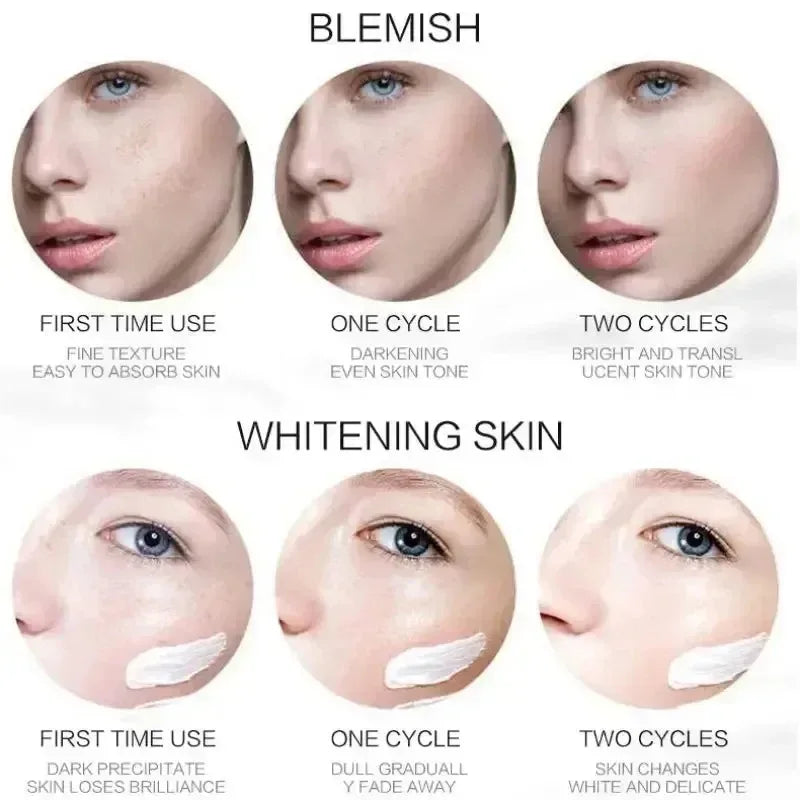 Whitening Freckle Cream Niacinamide Remove Dark Spot Cream Anti Freckle and Aging Cream Fade Pigmentation Melasma Skin