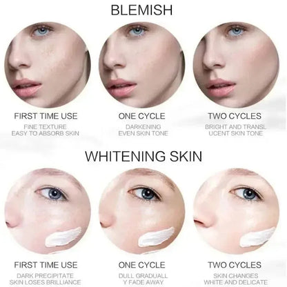 Whitening Freckle Cream Niacinamide Remove Dark Spot Cream Anti Freckle and Aging Cream Fade Pigmentation Melasma Skin