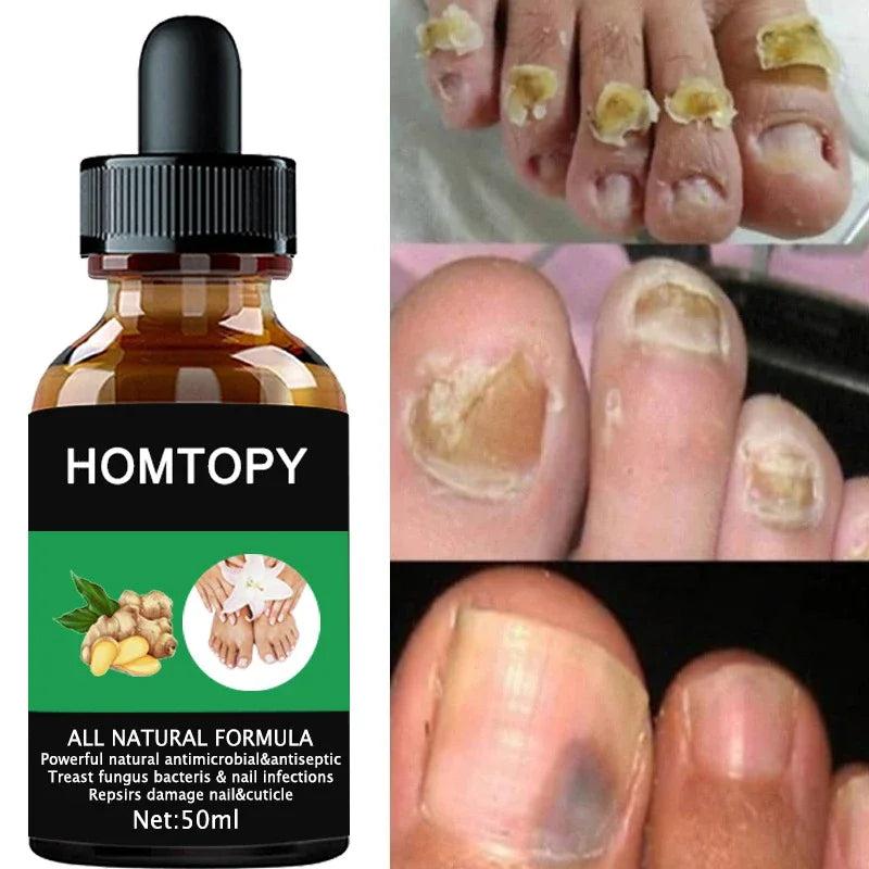 Efficient Nail Repair Solution Treating Cracked Discolored Nails Gray Foot Care Toe Nail Sterilization Nourishing Essence Uñas