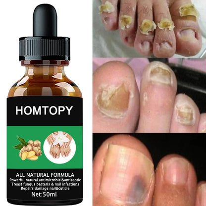Efficient Nail Repair Solution Treating Cracked Discolored Nails Gray Foot Care Toe Nail Sterilization Nourishing Essence Uñas