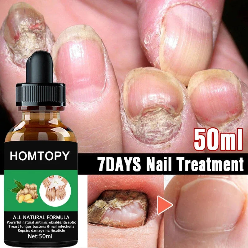 Efficient Nail Repair Solution Treating Cracked Discolored Nails Gray Foot Care Toe Nail Sterilization Nourishing Essence Uñas