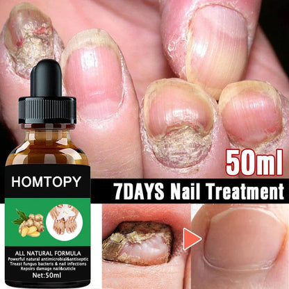 Efficient Nail Repair Solution Treating Cracked Discolored Nails Gray Foot Care Toe Nail Sterilization Nourishing Essence Uñas