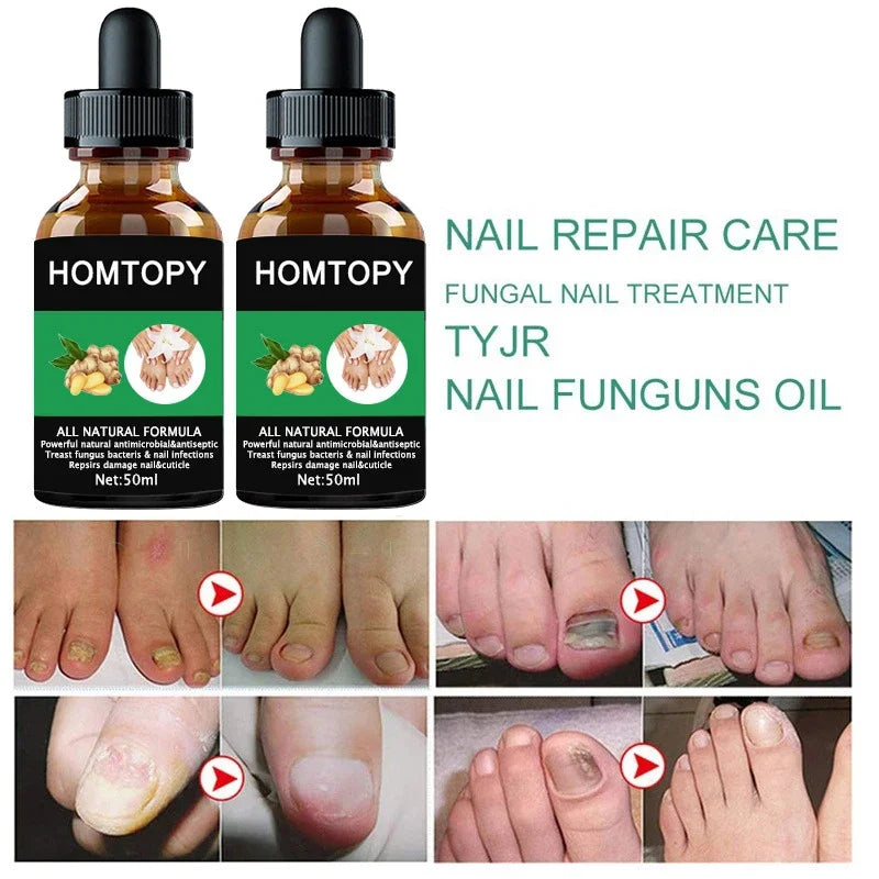 Efficient Nail Repair Solution Treating Cracked Discolored Nails Gray Foot Care Toe Nail Sterilization Nourishing Essence Uñas
