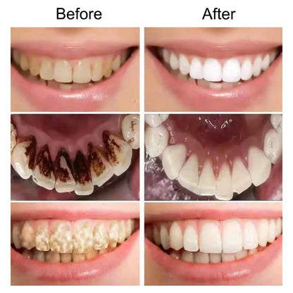 Whitening teeth Remove yellow , black spots, stains,  whitening essence powder, dental instruments, beauty liquid