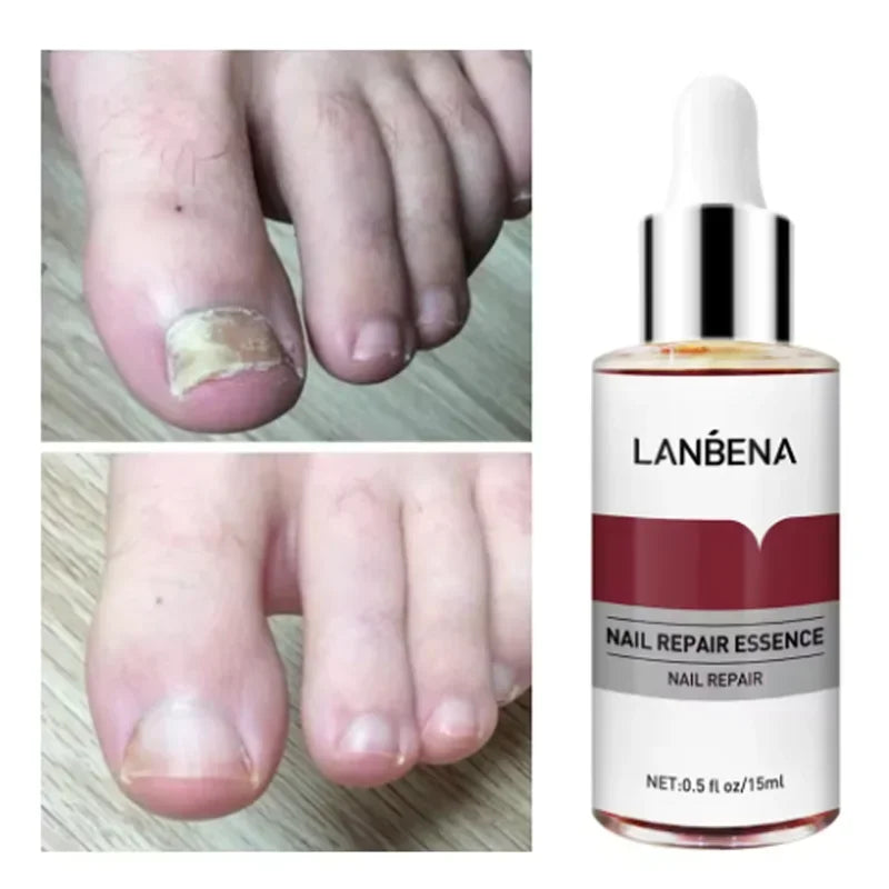 15mlFungus Care Remove Onychomycosis Toes Nourish Brighten Hands Feet Product Repair Suitable Women Nail Pepair Essencs