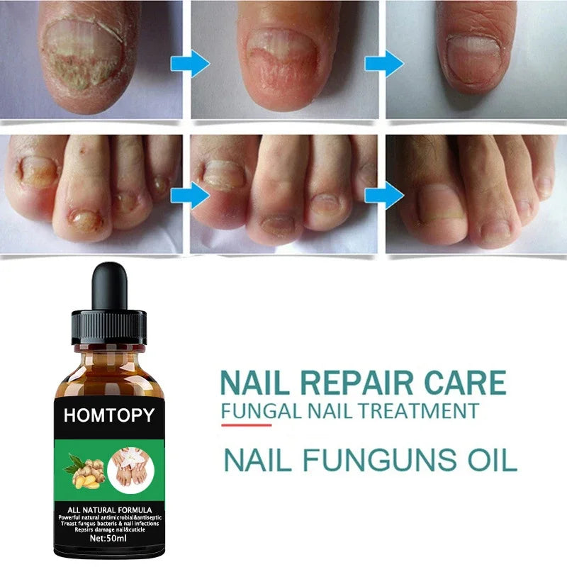 Efficient Nail Repair Solution Treating Cracked Discolored Nails Gray Foot Care Toe Nail Sterilization Nourishing Essence Uñas
