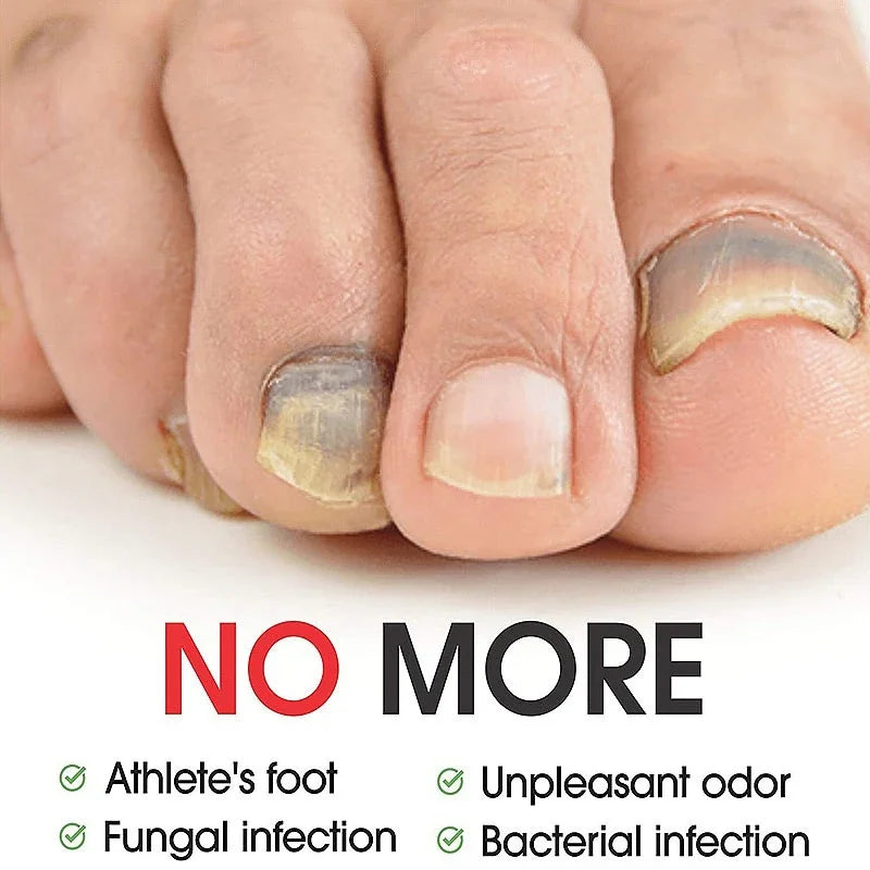 Efficient Nail Repair Solution Treating Cracked Discolored Nails Gray Foot Care Toe Nail Sterilization Nourishing Essence Uñas