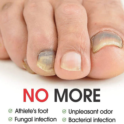 Efficient Nail Repair Solution Treating Cracked Discolored Nails Gray Foot Care Toe Nail Sterilization Nourishing Essence Uñas