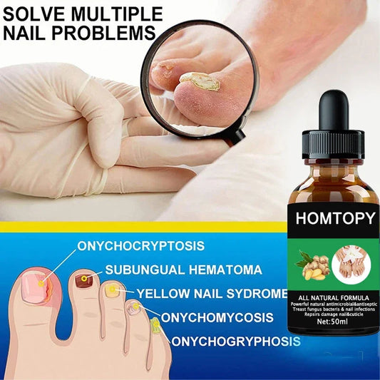 Efficient Nail Repair Solution Treating Cracked Discolored Nails Gray Foot Care Toe Nail Sterilization Nourishing Essence Uñas