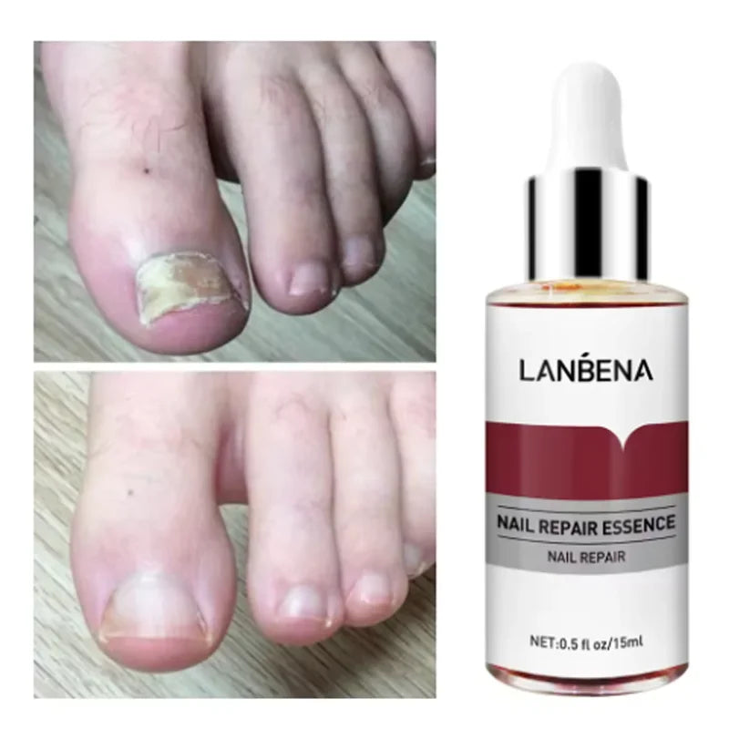 15mlFungus Care Remove Onychomycosis Toes Nourish Brighten Hands Feet Product Repair Suitable Women Nail Pepair Essencs