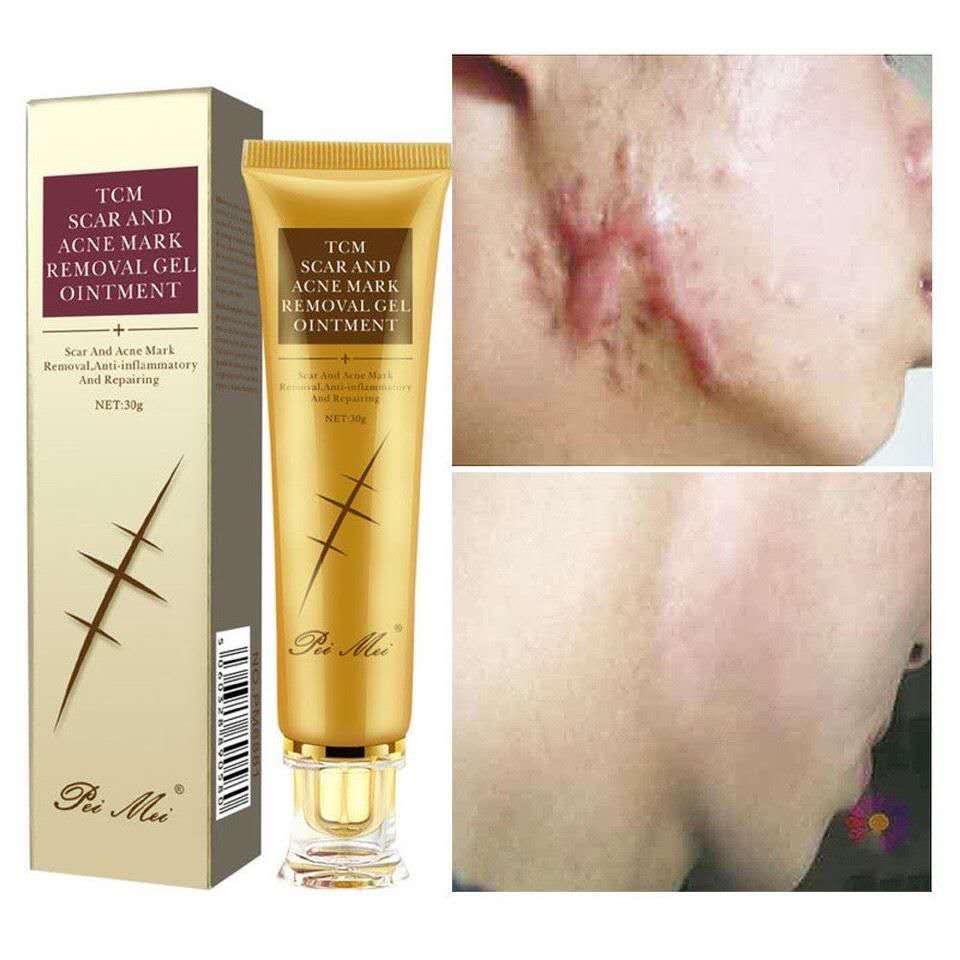 TCM Scar Acne Mark Removal Gel Ointment, 30g  (Available)