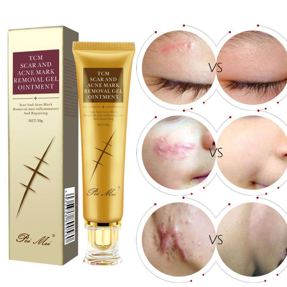TCM Scar Acne Mark Removal Gel Ointment, 30g  (Available)